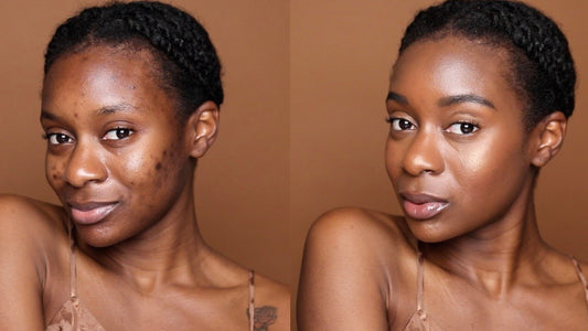 Understanding and treating Dark Spots